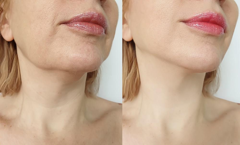 chin filler before and after