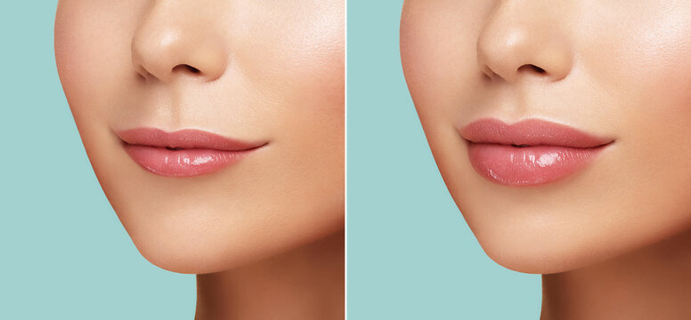 Lip Fillers before and after