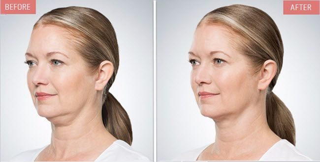 kybella before and after