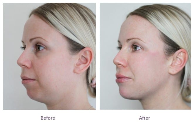 Chin Fillers before and after