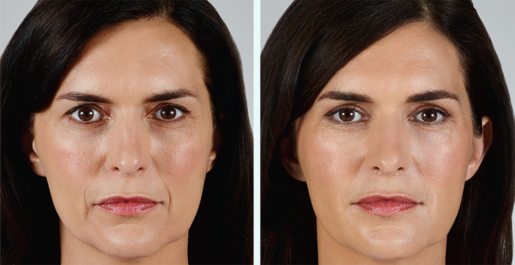 Juvéderm Filler Before and After