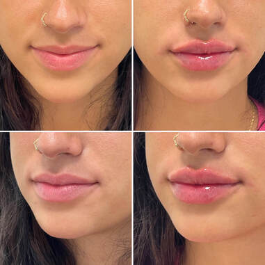 Lip Fillers before and after