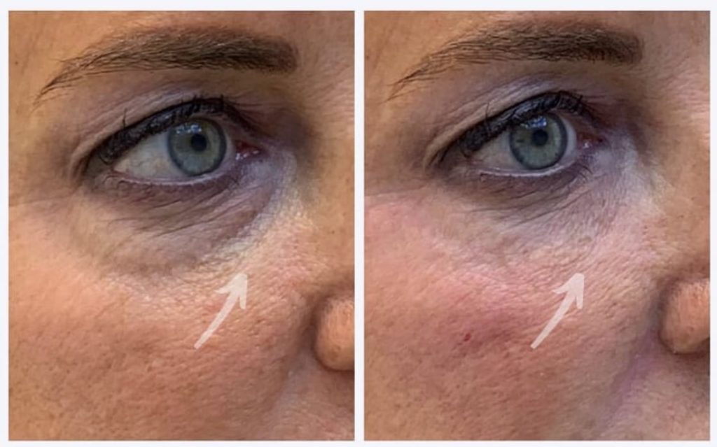 tear trough filler before and after