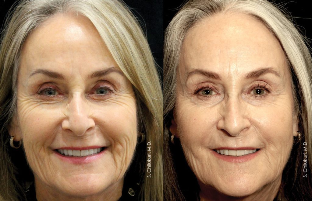 Skin Tightening Before and After