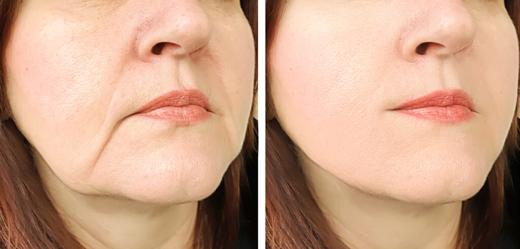 Cheek Filler Before and After