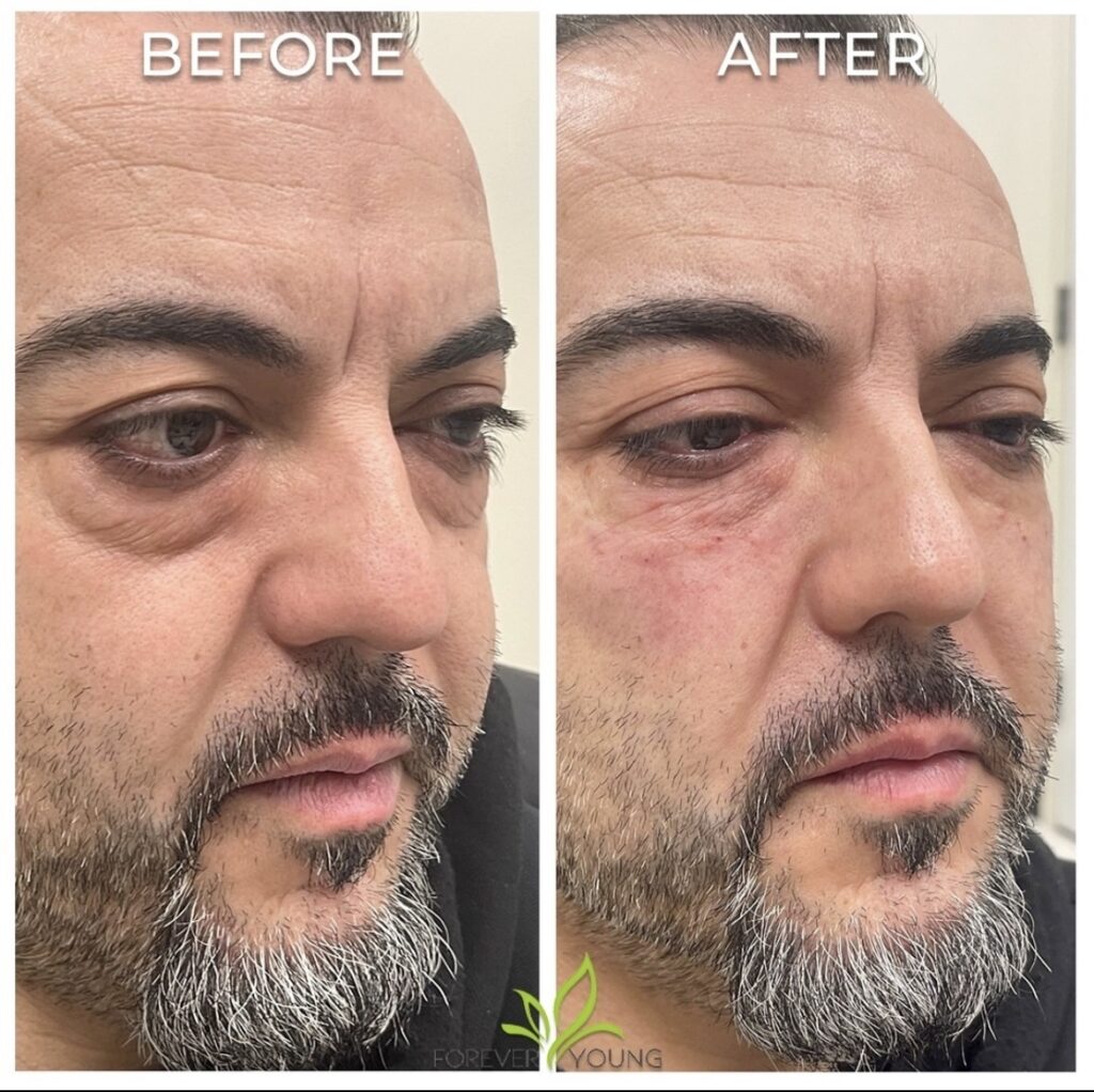 Under Eye Fillers