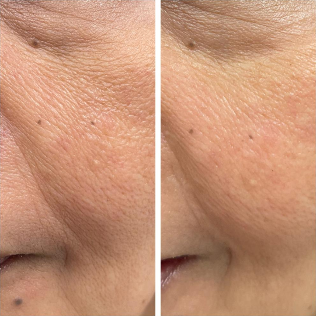 Skin Tightening, Wrinkle and Pore Reduction By Aerolase