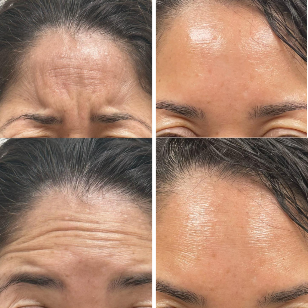 11s and Forehead Lines Removed With Botox